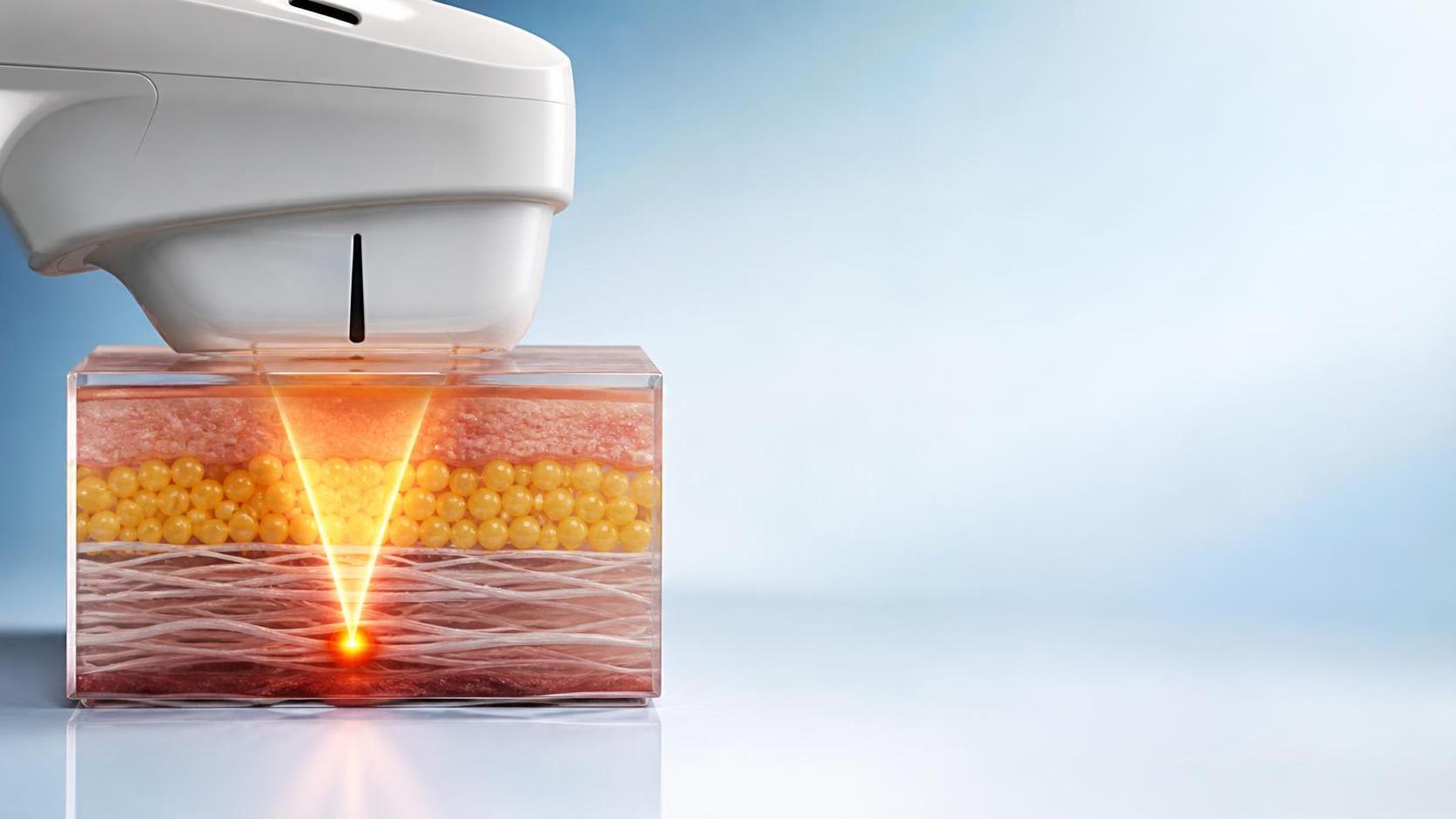 What Is SMAS Layer Lifting? Understanding How HIFU Targets Deep Facial Tissue