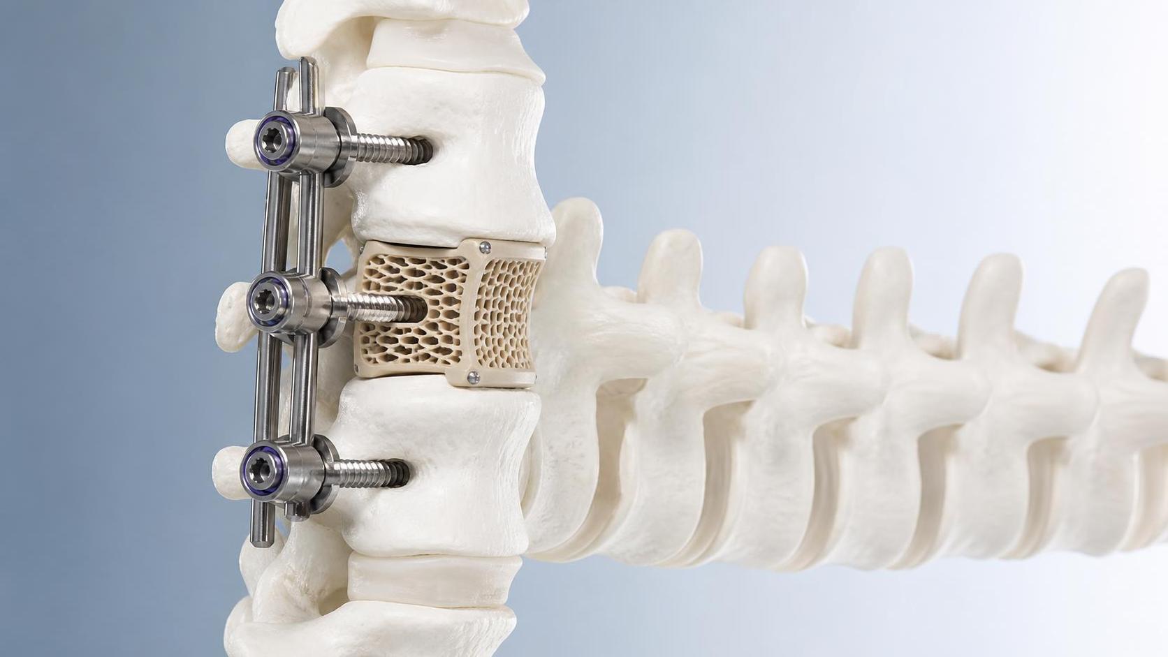 When are 3D printed PEEK implants suitable for spinal reconstruction?