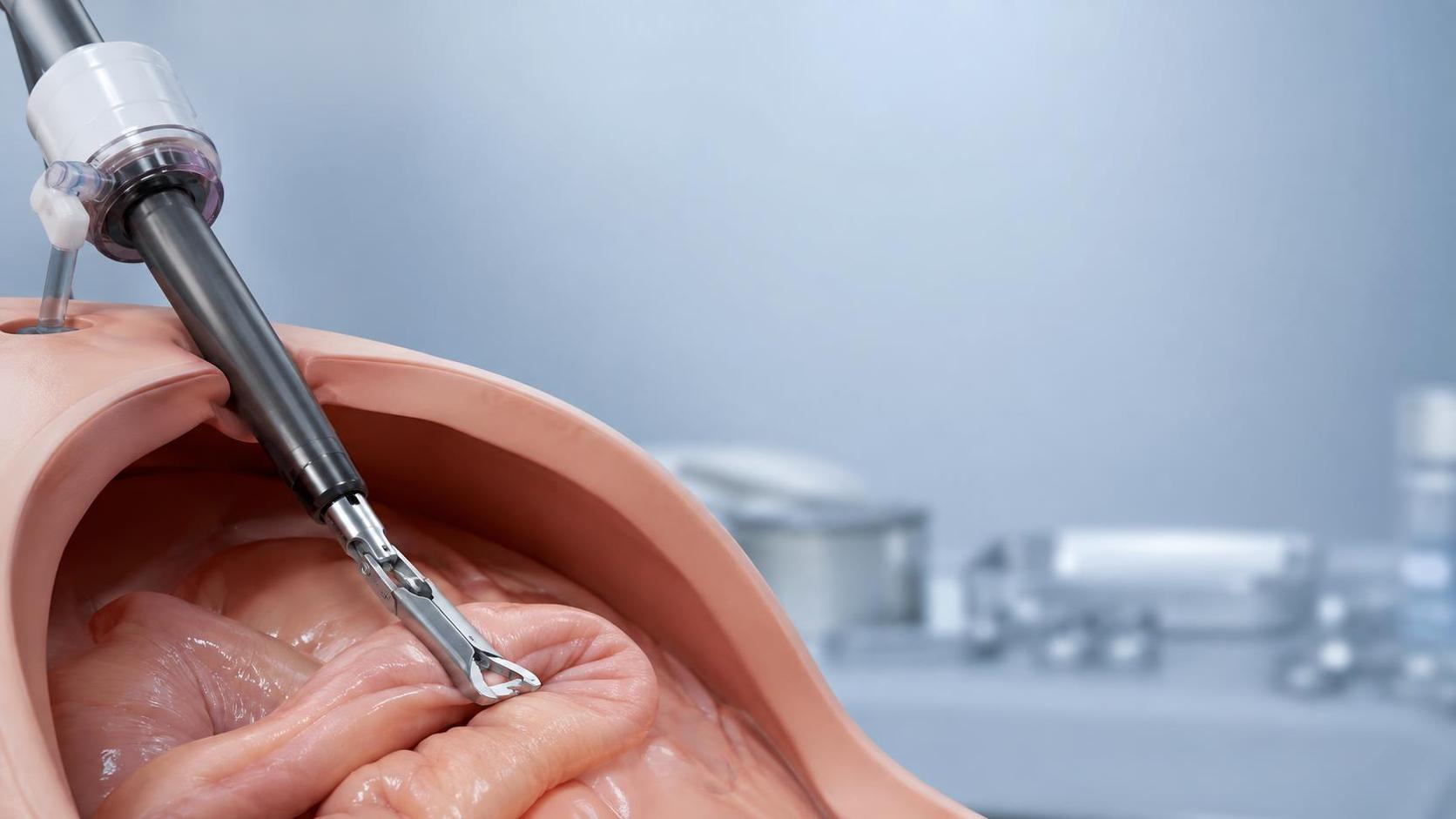 When do minimally invasive surgical staplers improve GI access?
