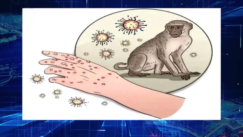 ¿Qué necesita saber sobre el virus de la viruela del mono?
