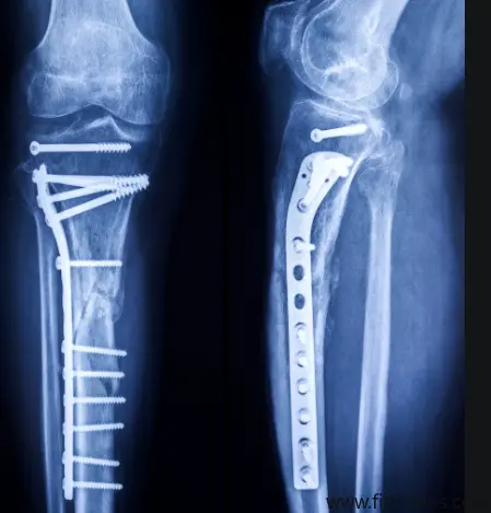 Research progress of surface modification of biomedical titanium alloy to improve wear resistance